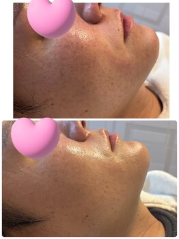ココサロン(Coco Salon)/毛穴洗浄ビフォアフ！