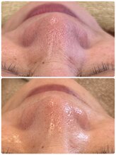 ユララ(YURARA)/小鼻がツルツル！！