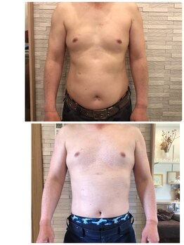 長寿鍼灸院 長寿整骨院/EMS＜お腹集中コース＞