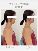 めい鍼灸院/リフトアップ美容鍼　小顔効果　