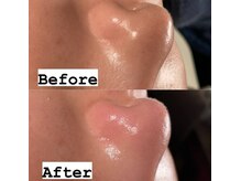 キキ(kiki)/元々きれいな方にも毛穴はある！