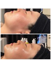 ベルフルール 西18丁目店/ハーブピーリング