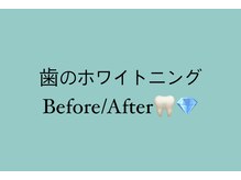 ホワイトニングショップ 明石大久保店/お客様のホワイトニング効果☆