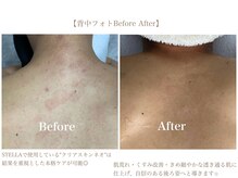 ステラ(STELLA)/背中フォト　Before After