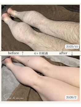 サロンド モーモ(SALON de mo-mo)/4ヶ月でこの結果:脚