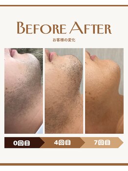 ビューティーサロンレモン(Lemon)/髭脱毛0回目～7回目