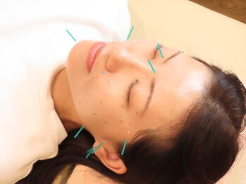 アカシア鍼灸整骨院の写真/～健康的に美しく～メイクしたままOK◎【美容鍼灸】と【表情筋トレーニング】でお顔のお悩みを根本改善！