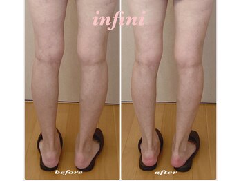 アンフィニ(infini)/下半身集中コース(2ヶ月)