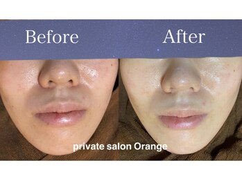 オレンジ(Orange)/剥離しないハーブピーリング