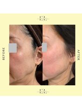 スプレール 水戸店/エクソリフト