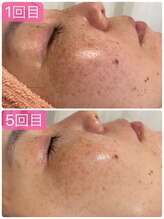 サロンドエテ(salon de ete)/シミシワケア、ハリのある水光肌