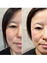 アーフ(ARF)/エクソリフト