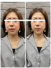 長寿鍼灸院 長寿整骨院/美容鍼50本の効果★小顔効果
