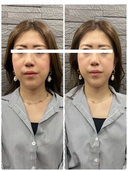 長寿鍼灸院 長寿整骨院/美容鍼50本の効果★小顔効果