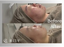 リリー(RILY)/【プラズマビフォーアフター】