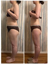 ベルミナ(Belmina)/大名/天神/毛穴/脱毛/痩身