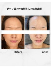 ココハリ/ダーマ鍼＋輪郭造形