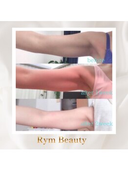 リム ビューティー(RYM BEAUTY)/最新超音波