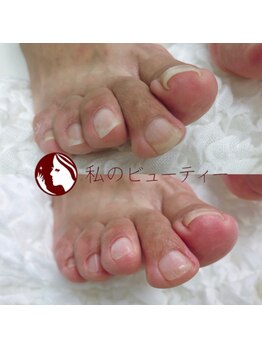 私のビューティー/巻爪カット