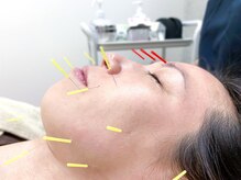 はり灸八角堂/美容鍼をして置鍼します♪