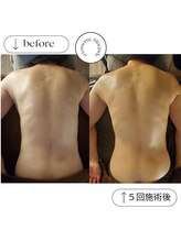 ブルー ジェイド(BLUE JADE)/筋膜リリース×５回