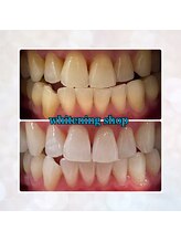 ホワイトニングショップ 奈良香芝店(Whitening shop)/学生さんもセルフホワイトニング