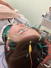 ハリスル 神戸訪問鍼灸付属治療院(harisuru)/浮腫の無くなりがすごい