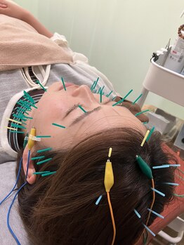 ハリスル 神戸訪問鍼灸付属治療院(harisuru)/浮腫の無くなりがすごい