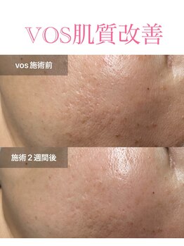 ティアーナ(Tiaana)/肌質改善VOSサロンケア