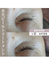 アップルミント/＜フェイシャル＞before・after