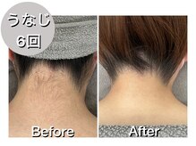 ナルシス/【脱毛】6回の変化★