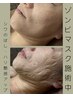 【期間限定メニュー◆】ゾンビマスクでシワのばし、引き締め☆50分8,000円