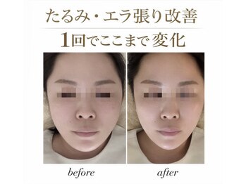 ピーエム(P.M)/エラ張りたるみ改善小顔ケア