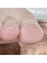 ヴォーグ(Vogue)/いたくない巻き爪緩和