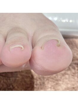 ヴォーグ(Vogue)/いたくない巻き爪緩和