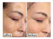 アワピール 成田公津の杜店(AWA PEELL)/ハーブピーリングで目尻シワ改善