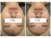 ウル(Ulu.)/コラーゲン爆弾施術♪