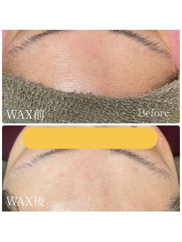 フレル(FUREL)/脱毛器でも除去できないのが産毛