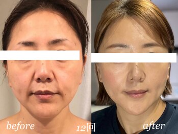 アトリエドゥアージュ(Atelier de age)の写真/福岡希少！最新しわ・たるみケア”光糸リフト”で年齢肌を変える大人女性のためのエイジングケア専門サロン