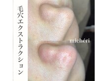 ミシェリ(micheri)/毛穴エクストラクション