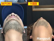 ハングアウト(HANGOUT)/【久留米メンズ脱毛】ヒゲ脱毛