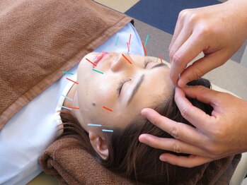 高田鍼灸カイロプラクティック/美容鍼で小顔に★