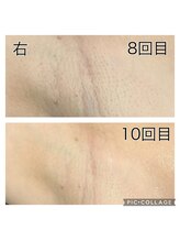 レイモード(Ray mode)/全身脱毛(顔脱毛あり)