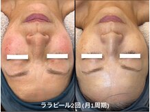 ユマニ バイ ヒート(Humani by HEAT)/赤ら顔の鎮静にも！ララピール♪