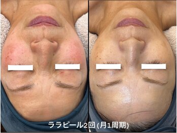 ユマニ バイ ヒート(Humani by HEAT)/赤ら顔の鎮静にも！ララピール♪