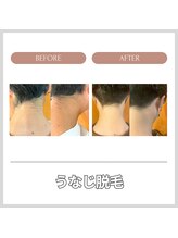 エクレ 今池店(EKURE)/うなじ脱毛