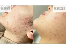 リーフィア(Leafia)/【思春期ニキビも改善◎】