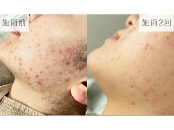 リーフィア(Leafia)/【思春期ニキビも改善◎】