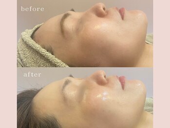 ミホノ 和泉中央店(mihono)/韓国艶肌！肌荒れ改善☆