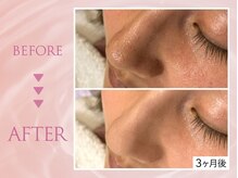 クリアラボ 池袋2nd(Clear Lab)/韓国肌管理&毛穴洗浄専門店